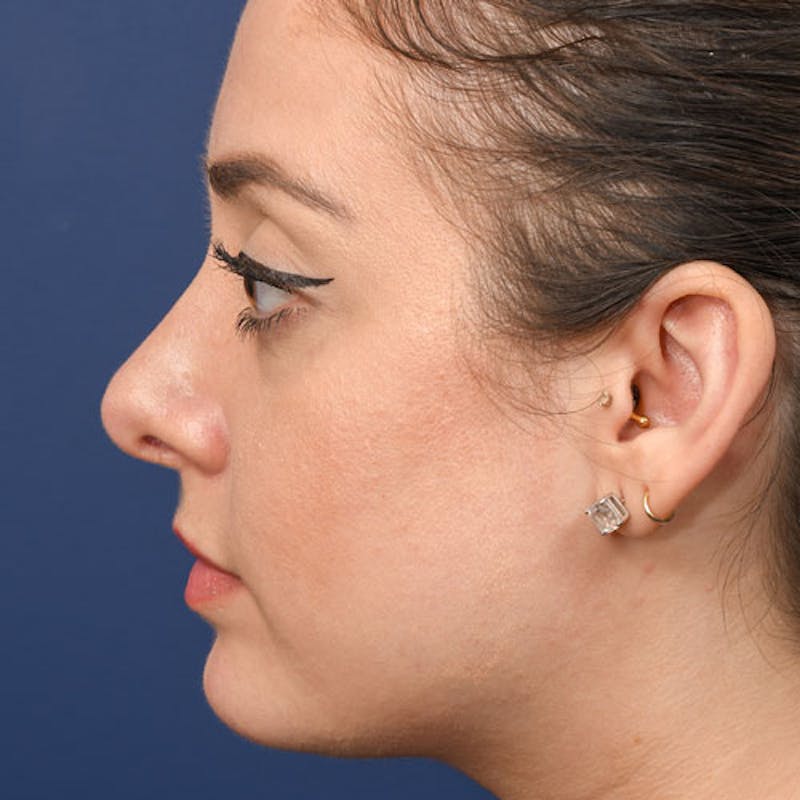 Chin Augmentation Before & After Gallery - Patient 97583666 - Image 2