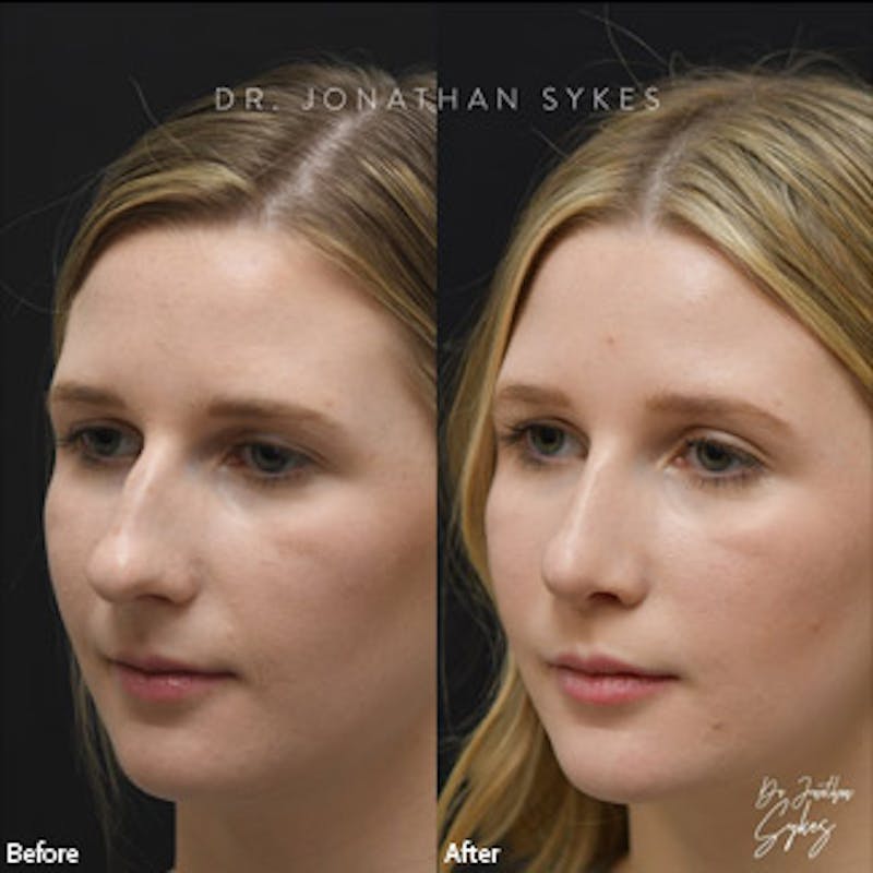 Rhinoplasty Before & After Gallery - Patient 97583645 - Image 3
