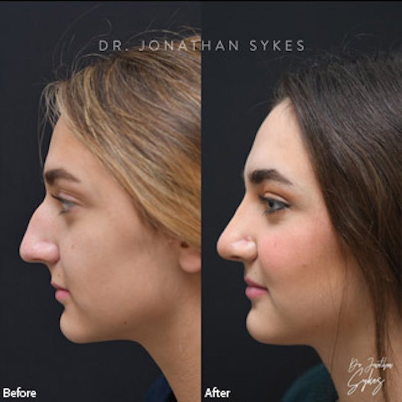 Rhinoplasty Before & After Gallery - Patient 97583665 - Image 2