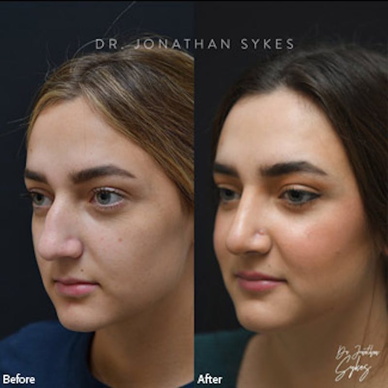 Rhinoplasty Before & After Gallery - Patient 97583665 - Image 3