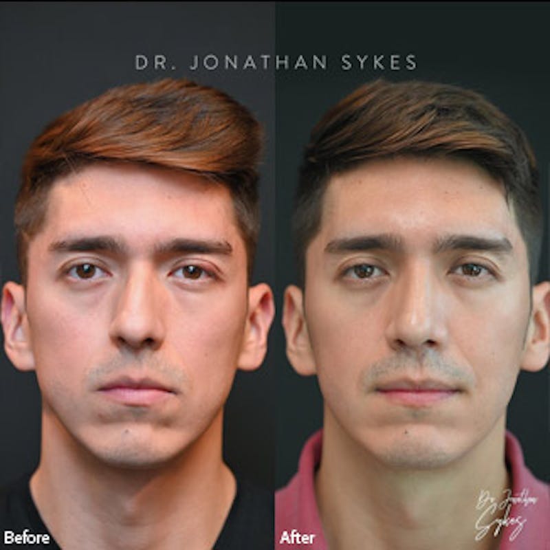Rhinoplasty Before & After Gallery - Patient 97583668 - Image 1