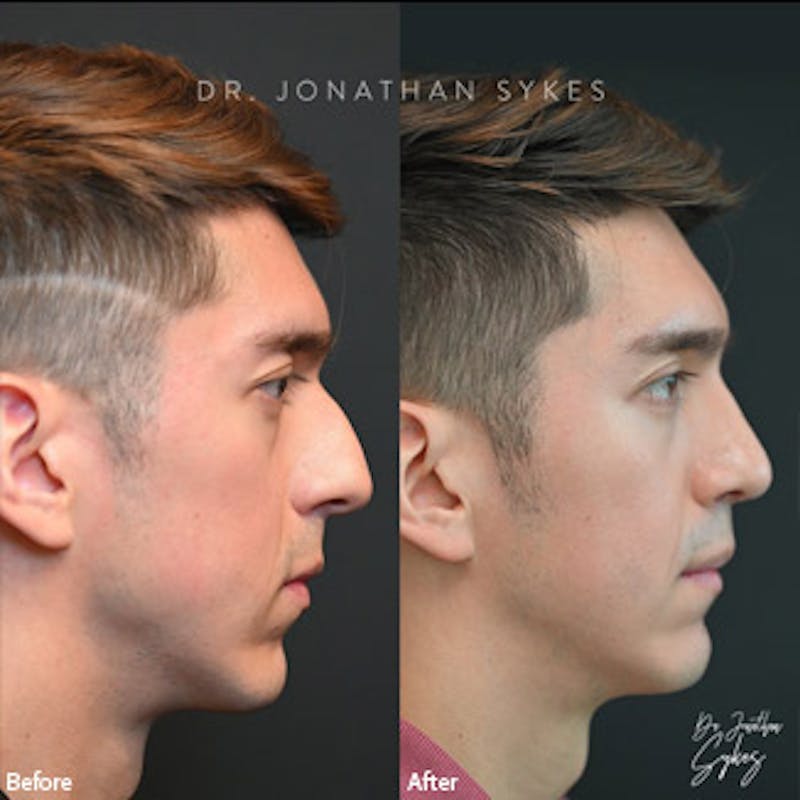 Rhinoplasty Before & After Gallery - Patient 97583668 - Image 2