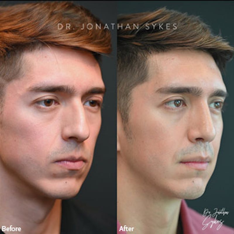 Rhinoplasty Before & After Gallery - Patient 97583668 - Image 3