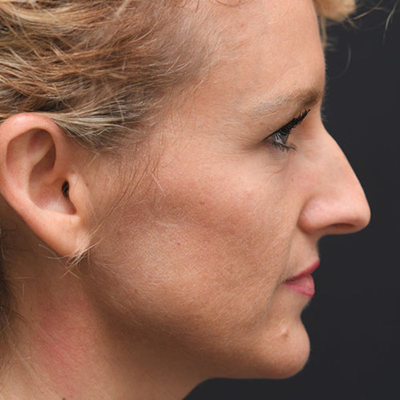 Rhinoplasty Before & After Gallery - Patient 97583684 - Image 1