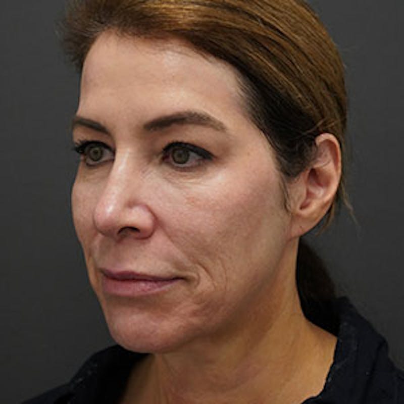 ThreadLift Before & After Gallery - Patient 97583686 - Image 1