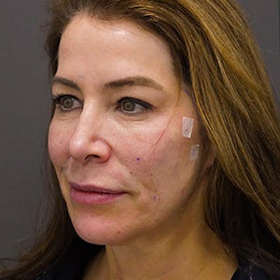 ThreadLift Before & After Gallery - Patient 97583686 - Image 2