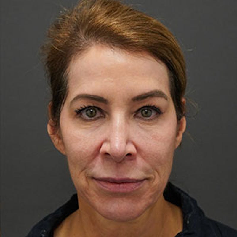 ThreadLift Before & After Gallery - Patient 97583686 - Image 3
