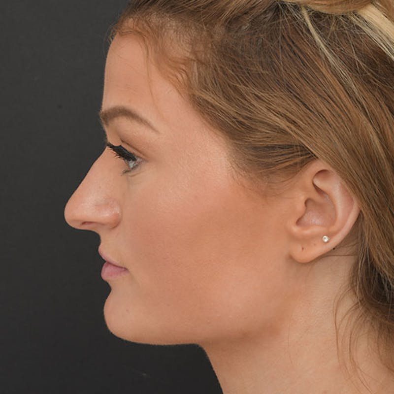 Rhinoplasty Before & After Gallery - Patient 97583688 - Image 1