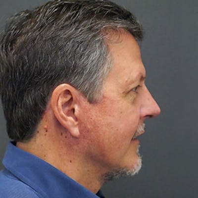 Chin Augmentation Before & After Gallery - Patient 97583685 - Image 2
