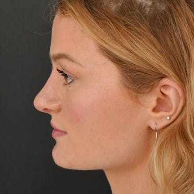 Rhinoplasty Before & After Gallery - Patient 97583688 - Image 2