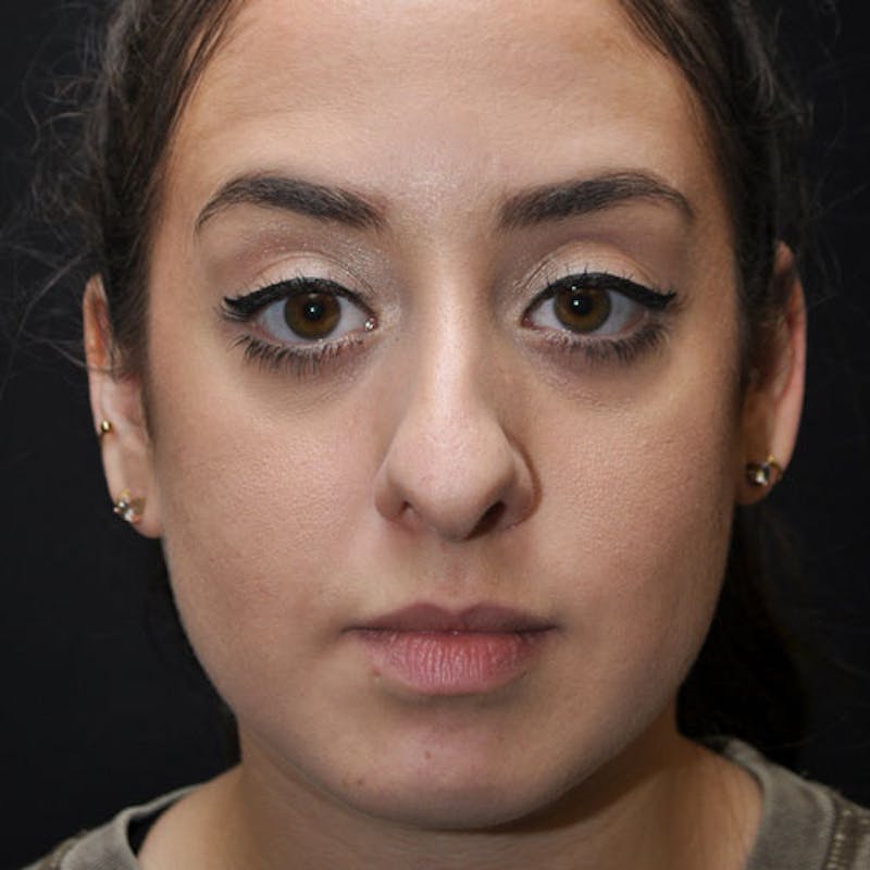 Rhinoplasty Before & After Gallery - Patient 97583700 - Image 3