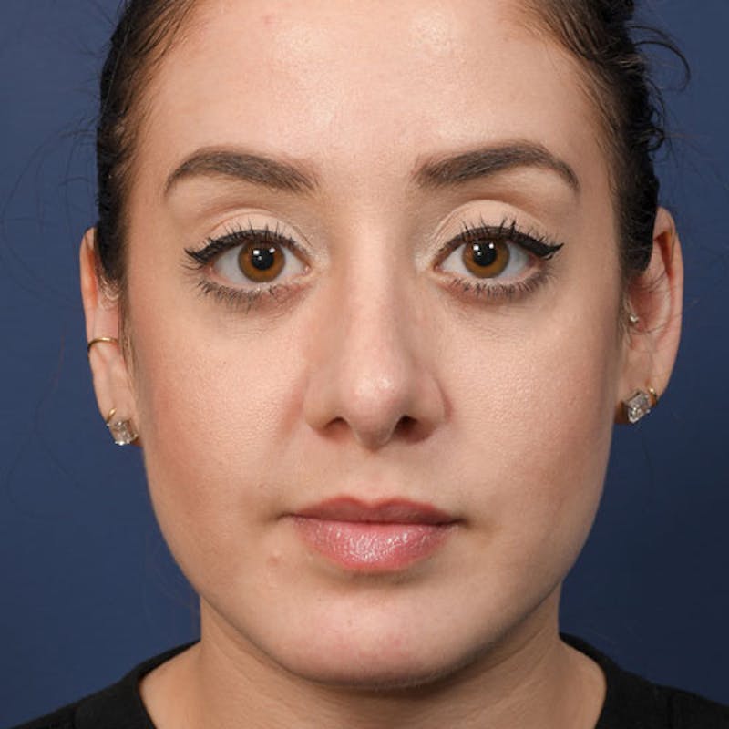 Rhinoplasty Before & After Gallery - Patient 97583700 - Image 4