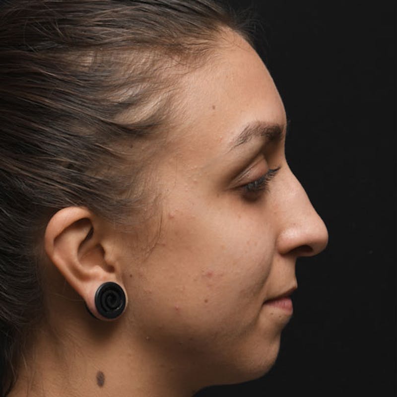 Rhinoplasty Before & After Gallery - Patient 97583745 - Image 1