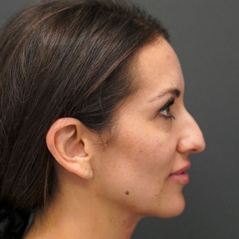 Rhinoplasty Before & After Gallery - Patient 97583748 - Image 1