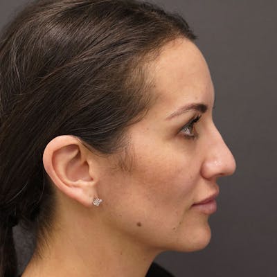 Rhinoplasty Before & After Gallery - Patient 97583748 - Image 2