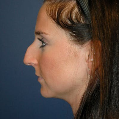 Rhinoplasty Before & After Gallery - Patient 97583753 - Image 1