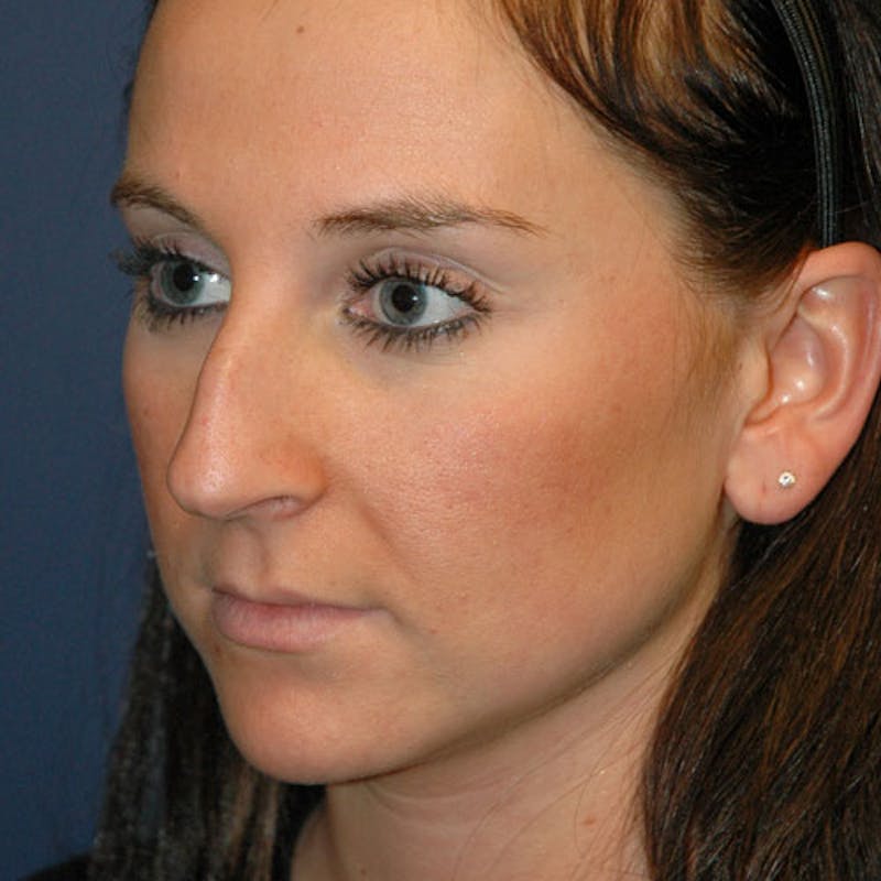 Rhinoplasty Before & After Gallery - Patient 97583753 - Image 3