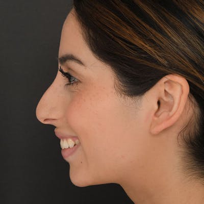 Rhinoplasty Before & After Gallery - Patient 97583763 - Image 1