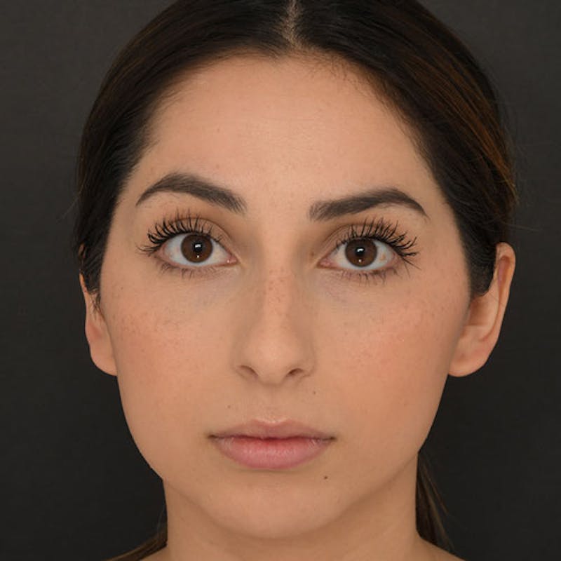 Rhinoplasty Before & After Gallery - Patient 97583763 - Image 3