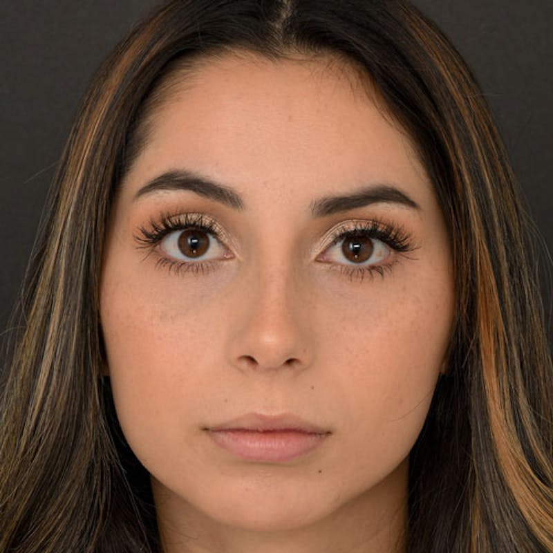 Rhinoplasty Before & After Gallery - Patient 97583763 - Image 4