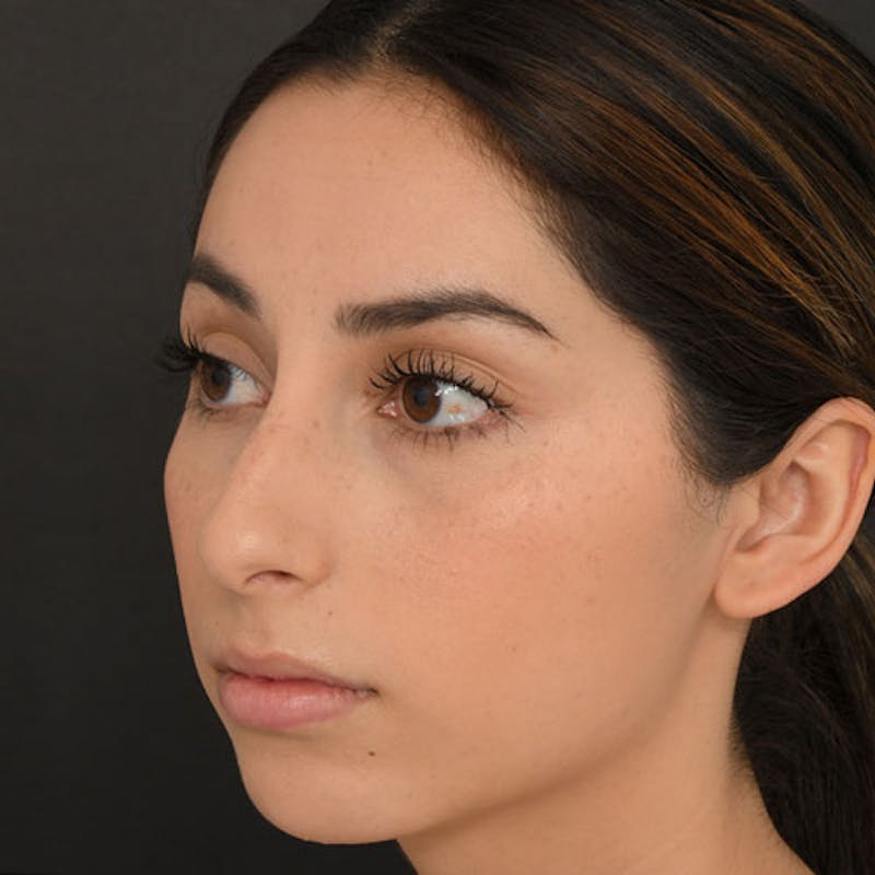 Rhinoplasty Before & After Gallery - Patient 97583763 - Image 5