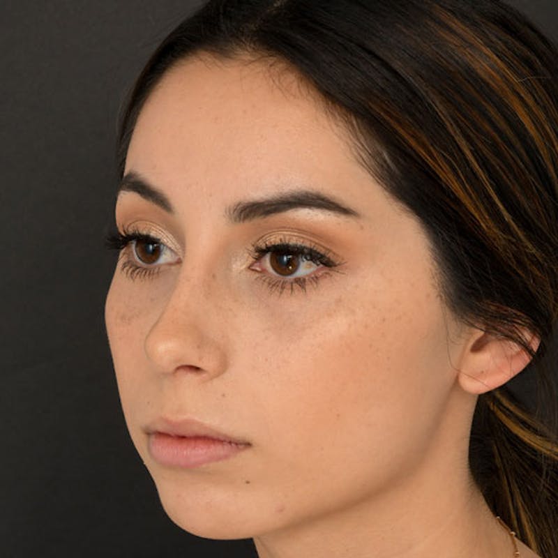 Rhinoplasty Before & After Gallery - Patient 97583763 - Image 6