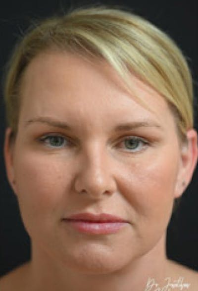 Facelift Before & After Gallery - Patient 97583434 - Image 2