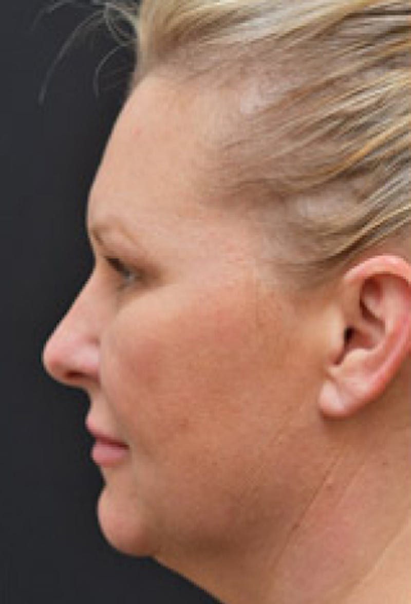 Facelift Before & After Gallery - Patient 97583434 - Image 3