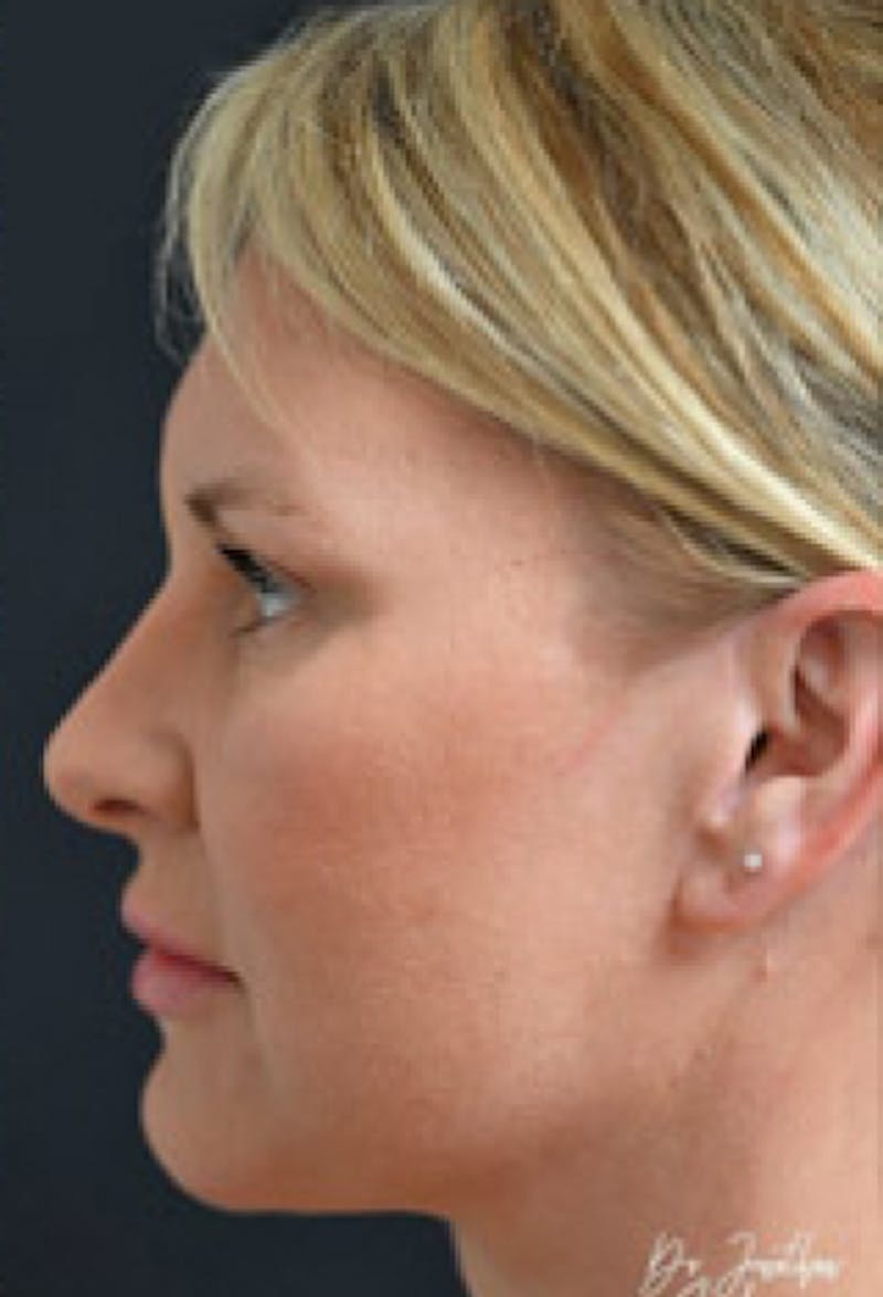 Facelift Before & After Gallery - Patient 97583434 - Image 4