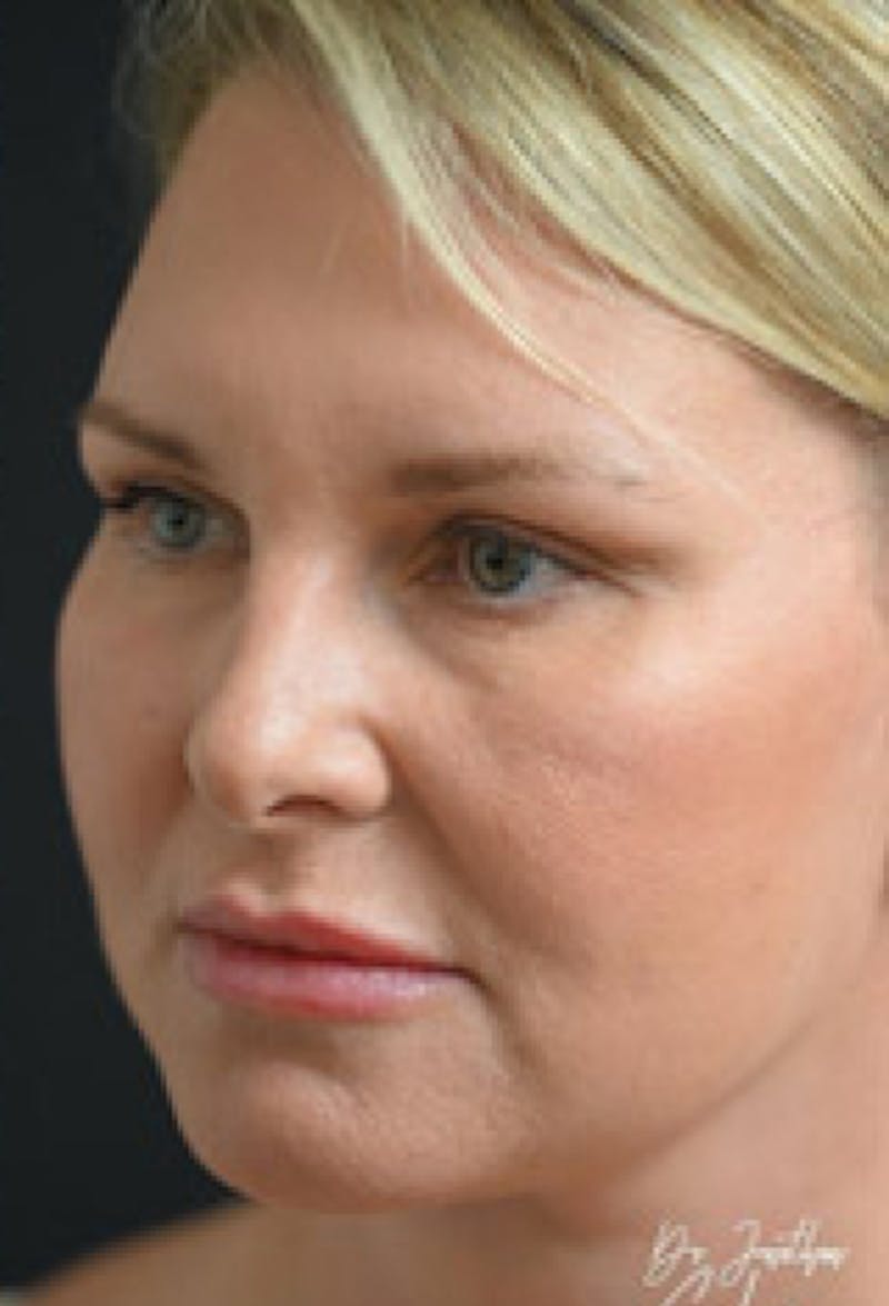 Facelift Before & After Gallery - Patient 97583434 - Image 6