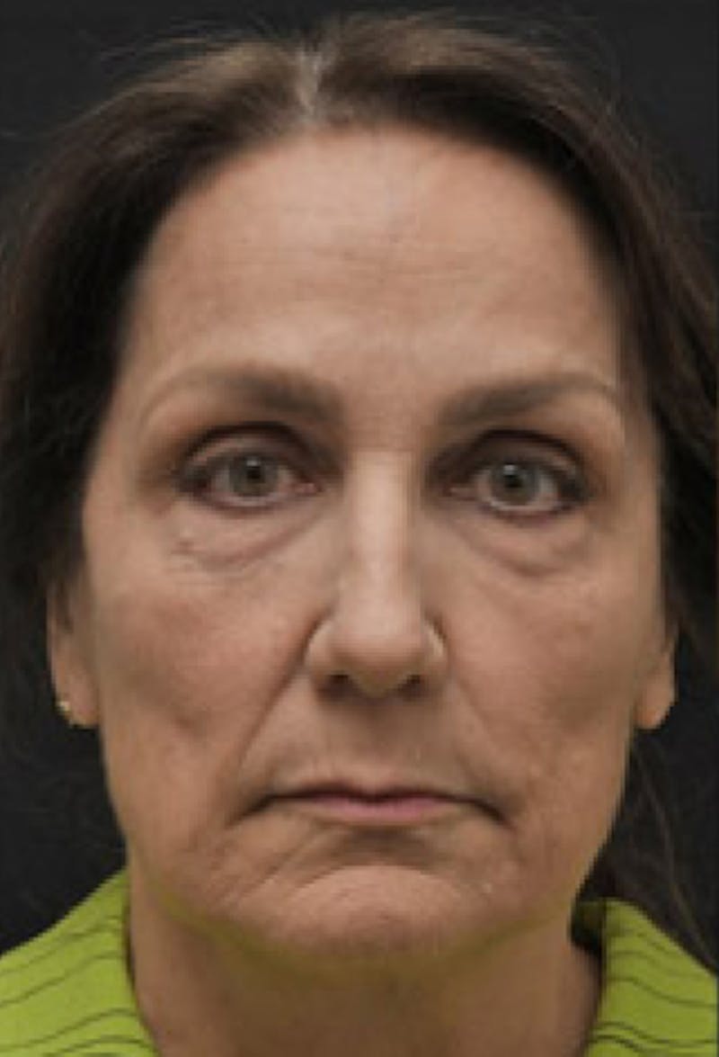 Facelift Before & After Gallery - Patient 97583451 - Image 1