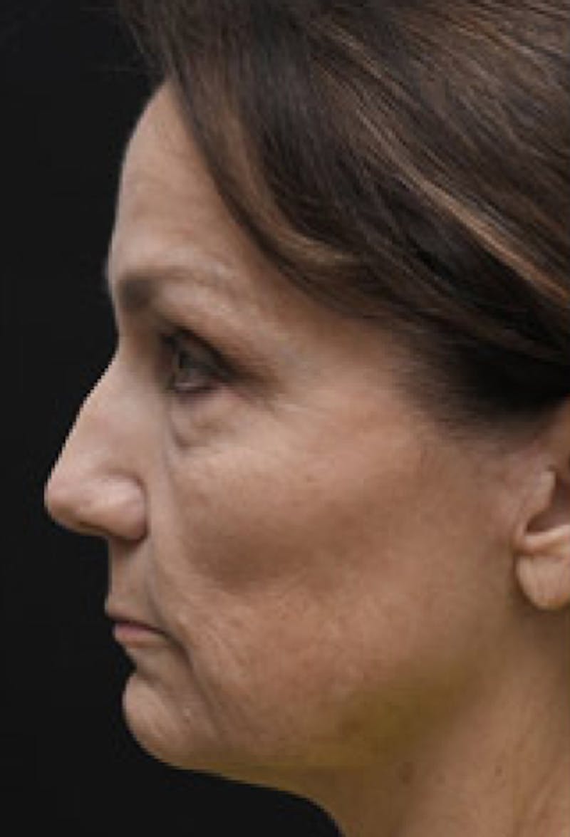 Facelift Before & After Gallery - Patient 97583451 - Image 3