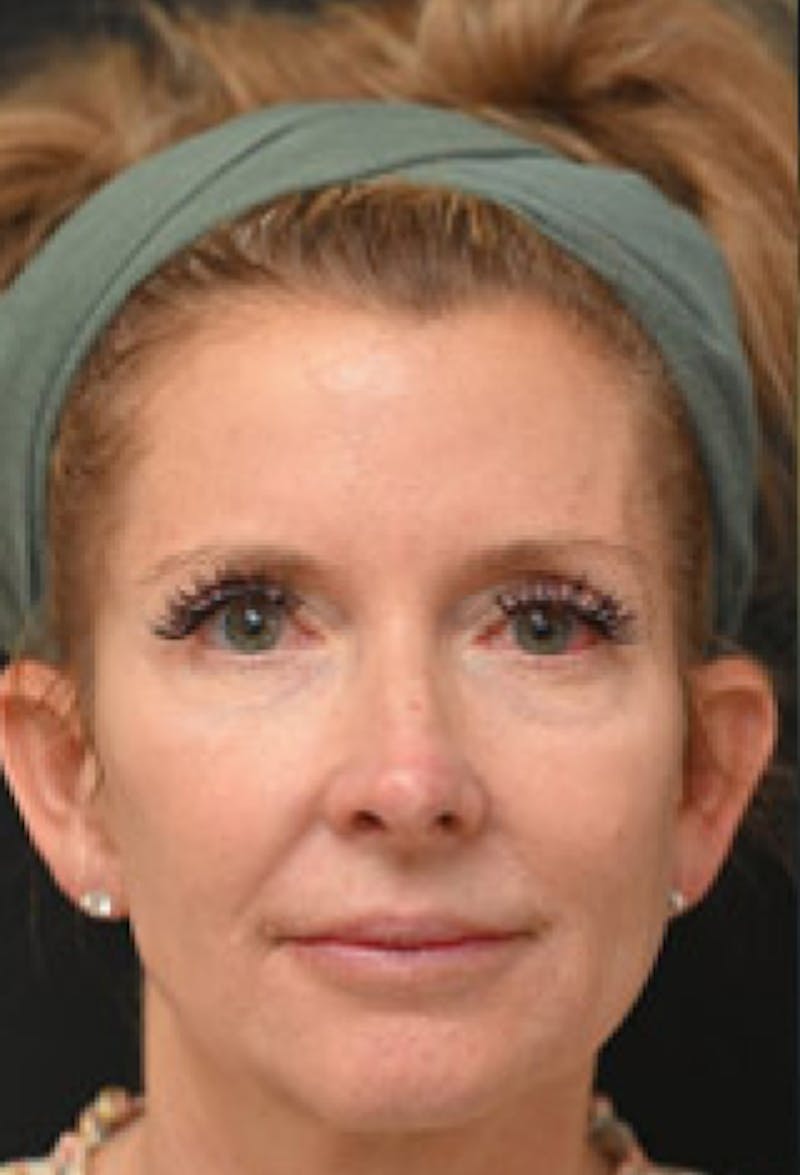 Facelift Before & After Gallery - Patient 97583428 - Image 1