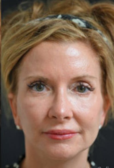 Facelift Before & After Gallery - Patient 97583428 - Image 2