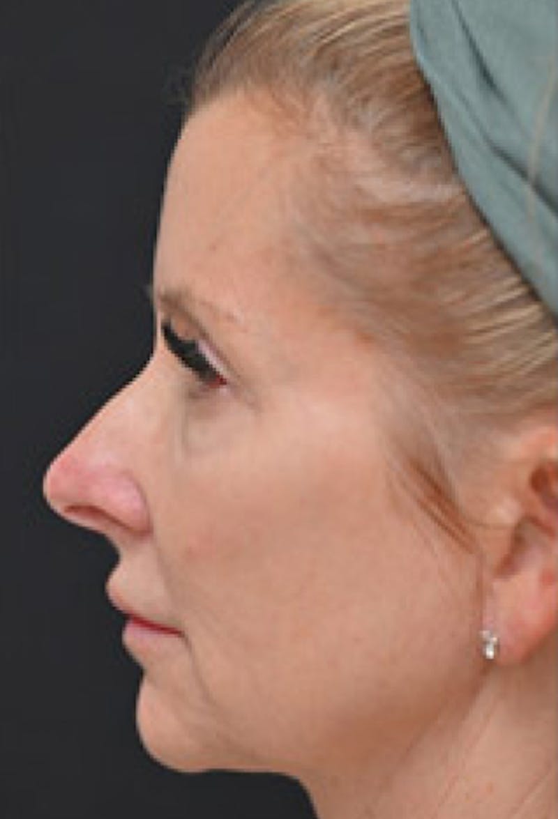 Facelift Before & After Gallery - Patient 97583428 - Image 3