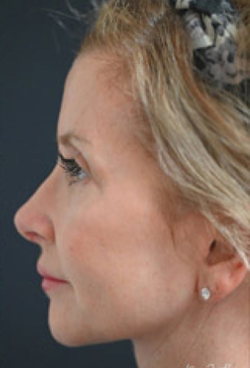 Facelift Before & After Gallery - Patient 97583428 - Image 4