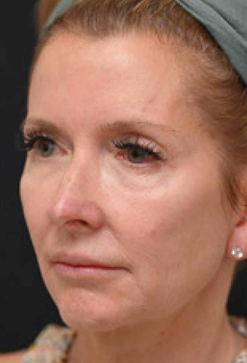 Facelift Before & After Gallery - Patient 97583428 - Image 5