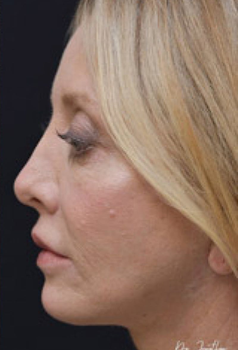 Lip Lift Before & After Gallery - Patient 97583545 - Image 4