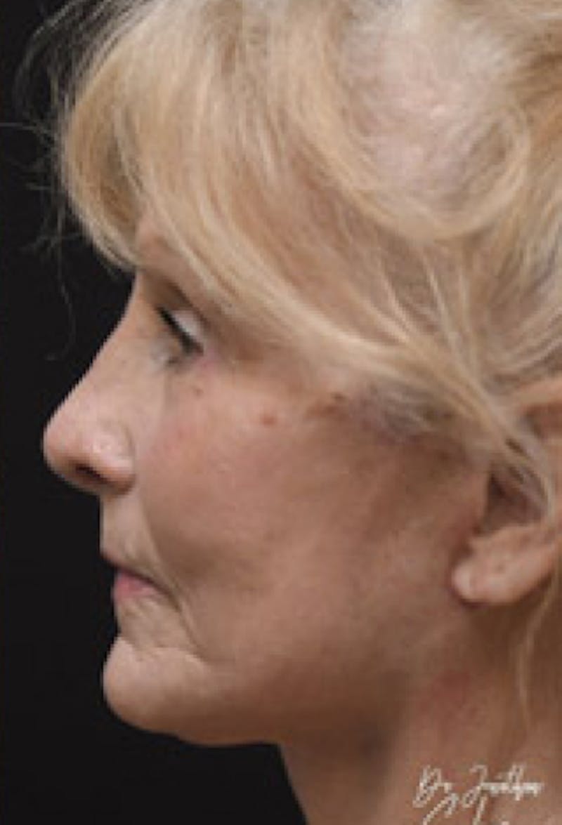 Blepharoplasty Before & After Gallery - Patient 97583606 - Image 4