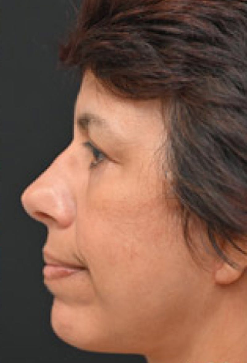 Blepharoplasty Before & After Gallery - Patient 97583608 - Image 4