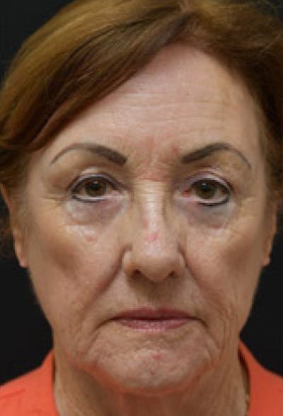 Blepharoplasty Before & After Gallery - Patient 97583609 - Image 1