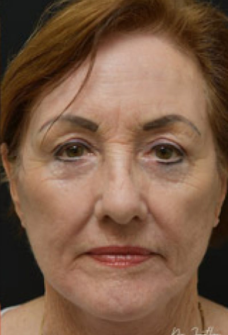Blepharoplasty Before & After Gallery - Patient 97583609 - Image 2