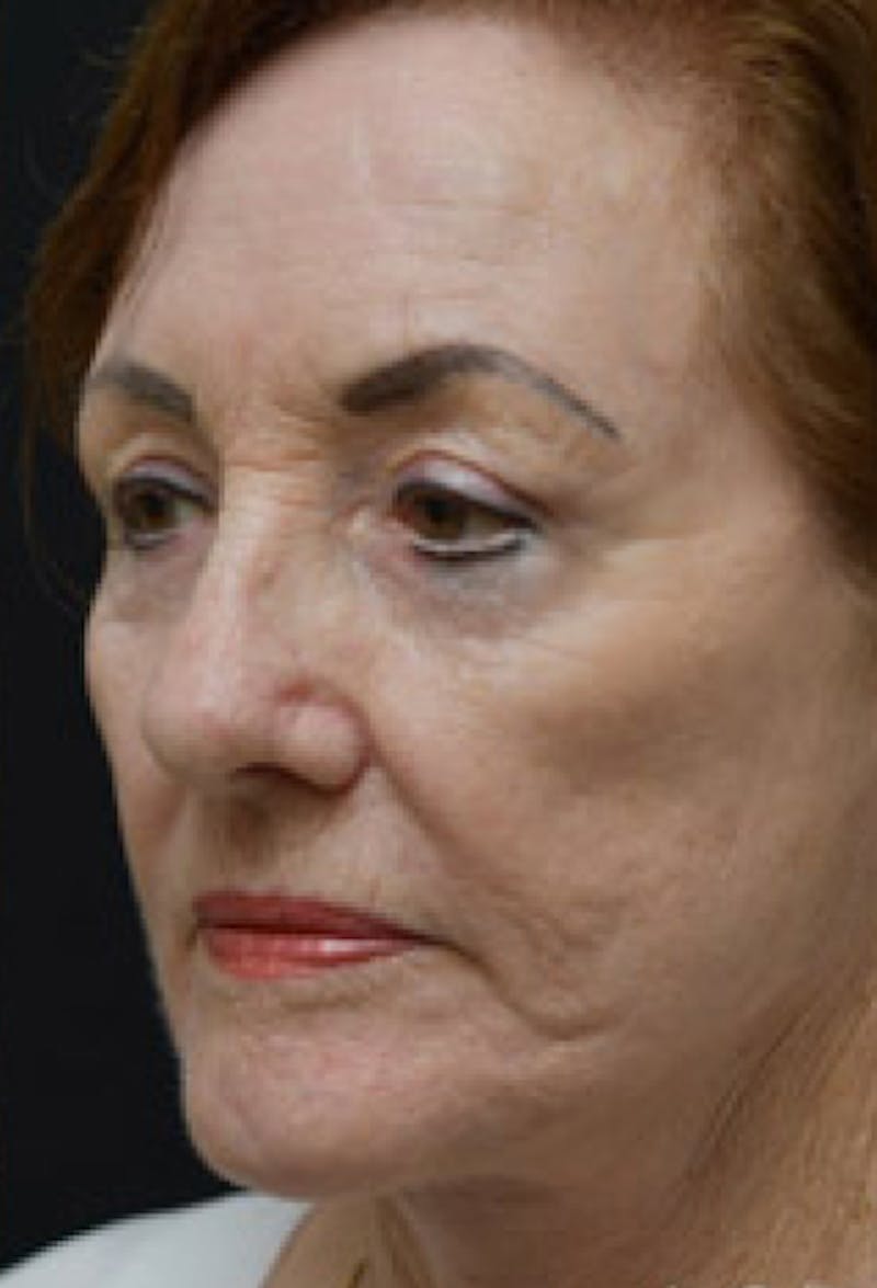 Blepharoplasty Before & After Gallery - Patient 97583609 - Image 6