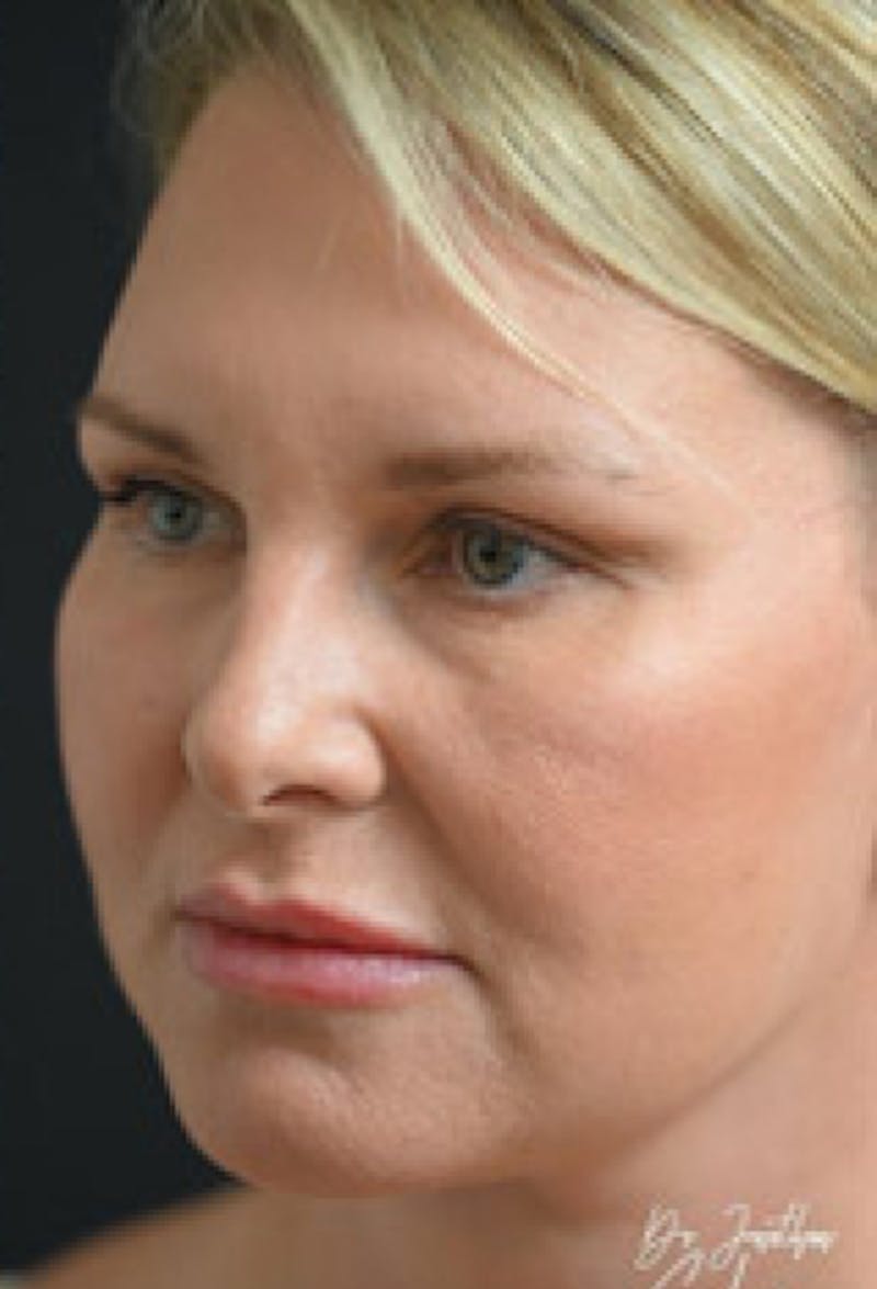 Blepharoplasty Before & After Gallery - Patient 97583611 - Image 6