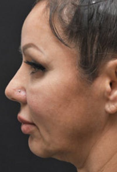 Chin Augmentation Before & After Gallery - Patient 97583610 - Image 1