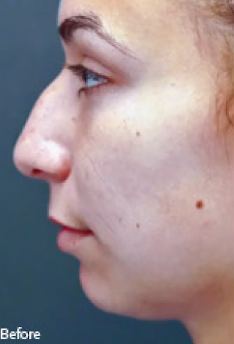 Chin Augmentation Before & After Gallery - Patient 97583612 - Image 1
