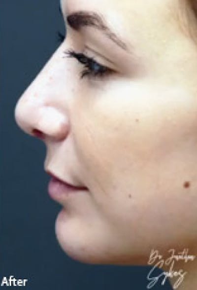 Chin Augmentation Before & After Gallery - Patient 97583612 - Image 2