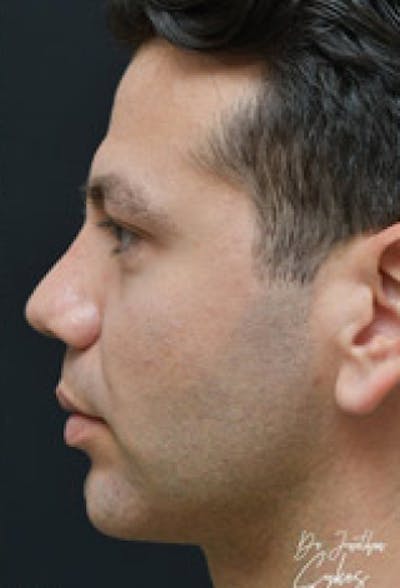 Chin Augmentation Before & After Gallery - Patient 97583627 - Image 2