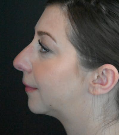 Chin Augmentation Before & After Gallery - Patient 106441117 - Image 2