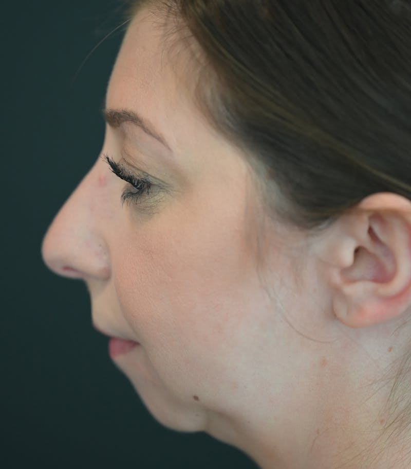 Chin Augmentation Before & After Gallery - Patient 106441117 - Image 1